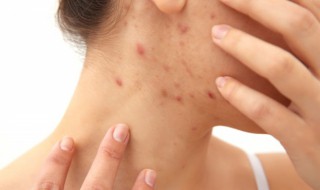 脸上反复长痘痘是怎么回事 女人脸上反复长痘痘是怎么回事