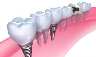 种牙好还是镶牙好（50岁种牙好还是镶牙好）