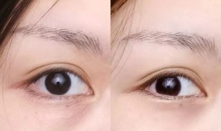 先天黑眼圈是怎么来的 先天黑眼圈是什么原因
