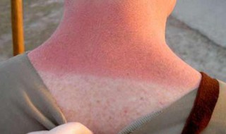 晒伤后皮肤痒怎么办（晒伤后皮肤痒怎么办）