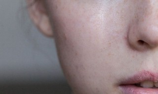 春季脸上长痘痘红痒是怎么回事 脸上长红痘痘发痒是怎么回事