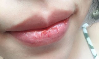 嘴唇很干燥为什么（嘴唇很干燥为什么不能舔）