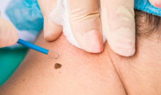 全身最有福气的痣（全身最有福气的痣图解）