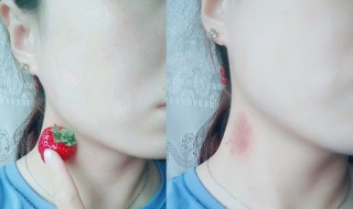三分钟快速消除草莓印（三分钟快速消除脖子吻痕）