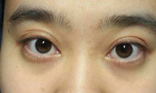 黑眼袋很重怎么办 黑眼袋很严重