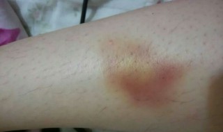 如何有效去除淤青 如何有效去除淤青的方法
