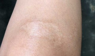 老伤疤怎么去掉（老伤疤怎么去掉图片）