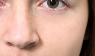 鼻子上有雀斑怎么办（鼻子上有雀斑怎么办是什么原因）