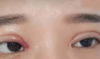 肿眼皮是怎么回事 天天肿眼皮是怎么回事