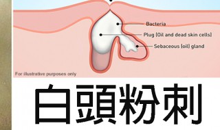 脸上长粉刺是什么原因怎样去掉（脸上长粉刺是什么原因怎样去掉小妙招）