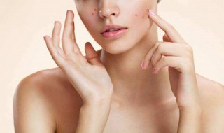 茶树精油祛痘方法（茶树精油祛痘使用方法）