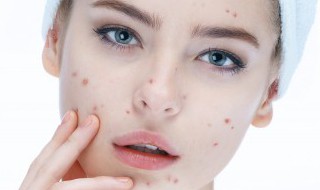 痘印留下的黑色素怎么去除（好多年前的痘印留下的黑色素怎么去除）