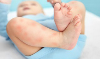 痱子怎么消除(嘴巴痱子怎么消除)