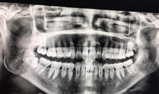 怎么算露牙龈 露牙龈是龅牙吗