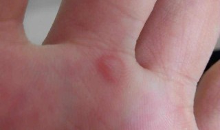 去手上中指茧小妙招（怎么去手指茧）