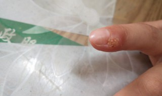 鱼鳞痣怎么祛除 鱼鳞痣怎么祛除掉