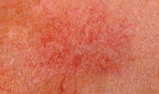 什么是蜘蛛痣（什么是蜘蛛痣图片）