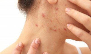 吃辣起痘痘怎么治 吃辣长痘痘怎么回事