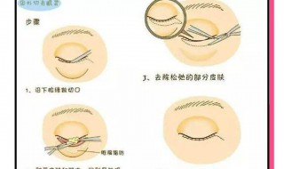 如何去除眼袋的方法 如何去除眼袋的方法图片