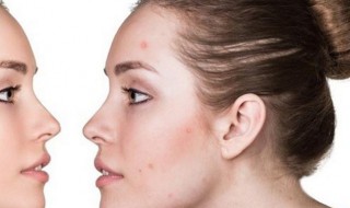 痘印能彻底消除吗 痘印能彻底消除吗图片