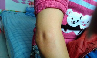 胳膊肘黑粗糙怎么去除（胳膊肘黑粗糙怎么去除图片）