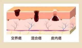 肩膀上有痣代表什么 男人肩膀上有痣代表什么