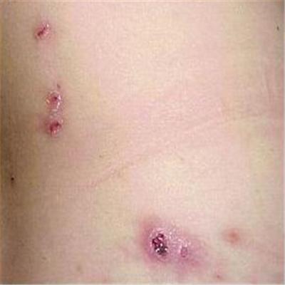 身上长血痂点怎么办