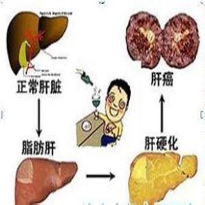 脂肪肝的早期症状是什么呢