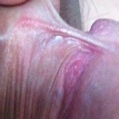 包皮系带敏感的危害有哪些