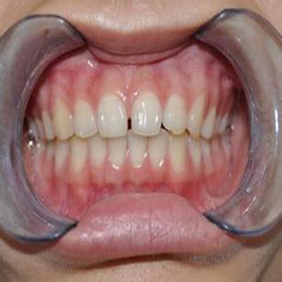 前牙深覆盖的原因有哪些