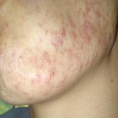 为什么下巴总是长痘痘