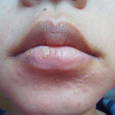 唇炎的治疗方法有哪些