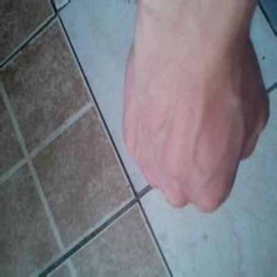 手背血管突起怎么办