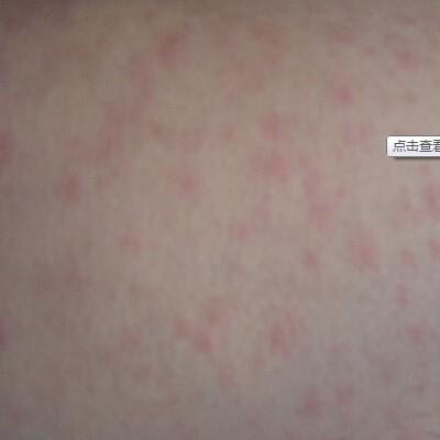 小腿有红斑不痒不痛是怎么回事