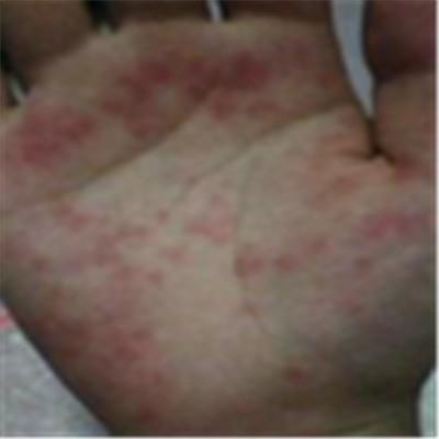 手指上有小红点怎么回事