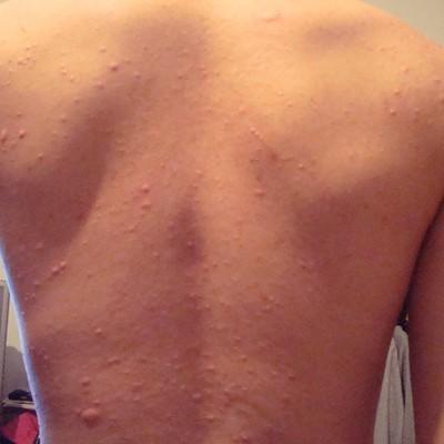 身上出现好多小红痣怎么回事