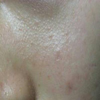 脸上长白色的小米粒是怎么回事