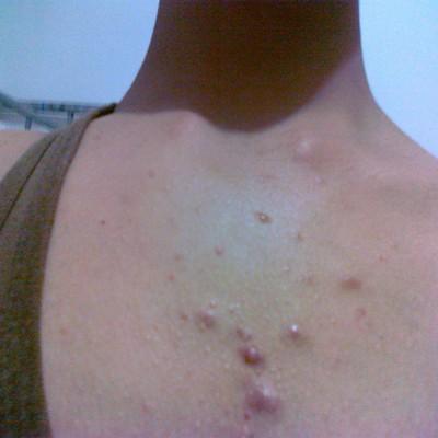 胸前长红疙瘩怎么办