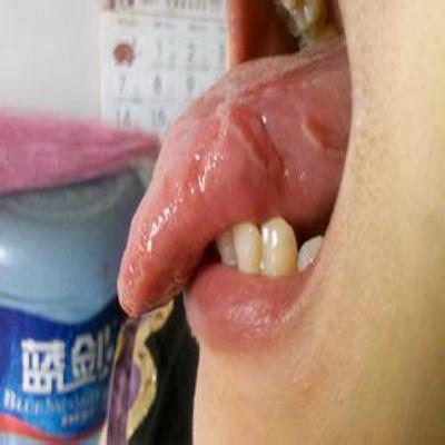 舌头边缘有白色块状物是什么