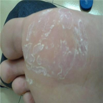 脚底脱皮是什么原因