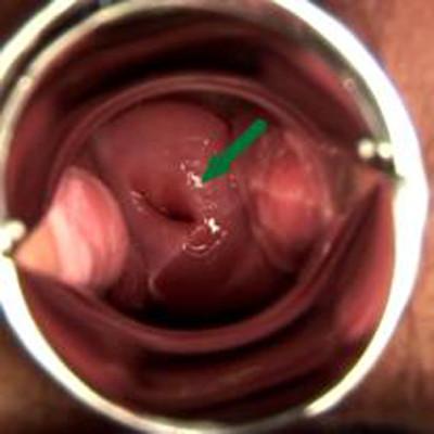 扩阴器的使用方法有哪些