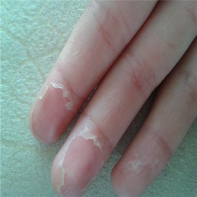 手掉皮怎么回事