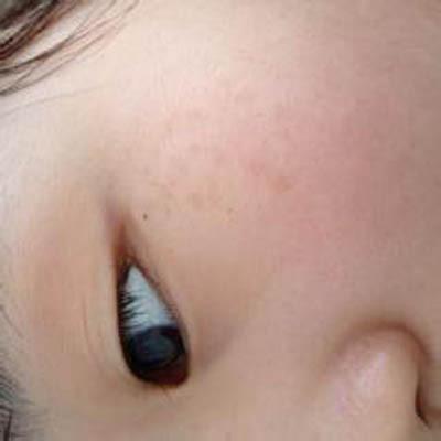 颧骨长斑是什么原因