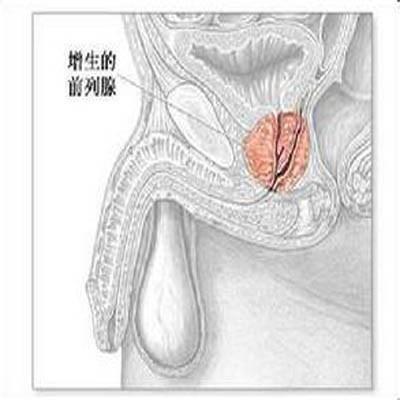 前列腺增生手术费用是多少