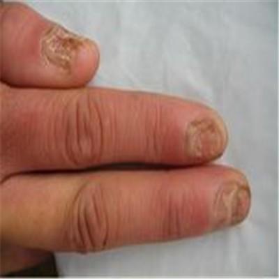 甲沟炎导致骨髓炎怎么办