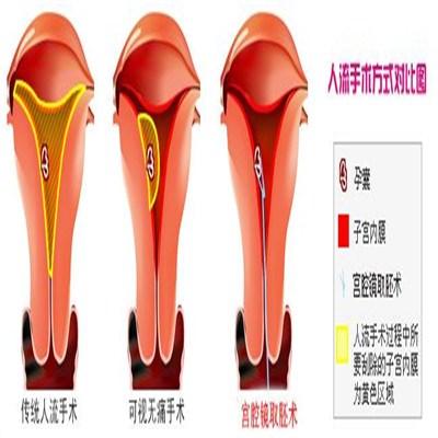 宫腔镜手术怎么样