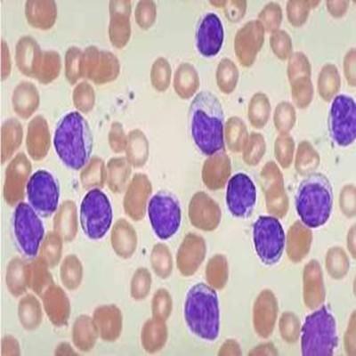 淋巴细胞比率偏高的原因是什么