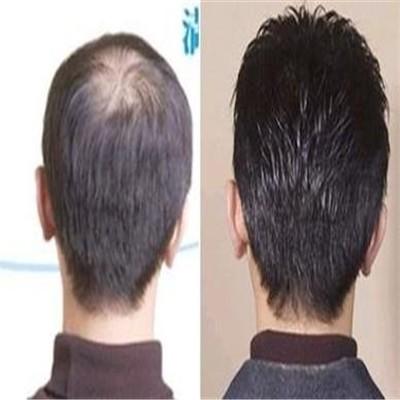 谢顶一般发生在什么年龄