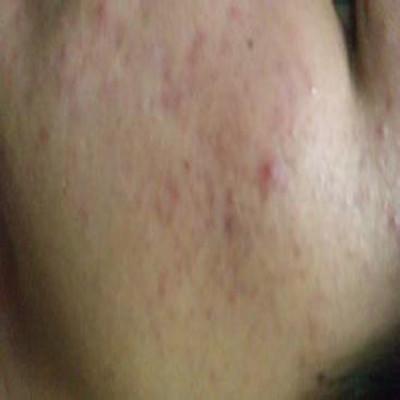 脸上痘印怎么快速去除