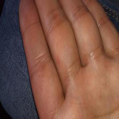 手指疱疹怎么办